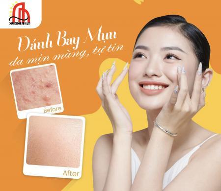 Công Nghệ Trị Mụn: IPL - Plasma Lạnh  - Gren PDT Tại An An Spa Gia Lai