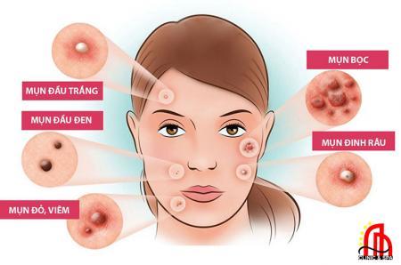 Các bước chăm sóc da mụn tại nhà